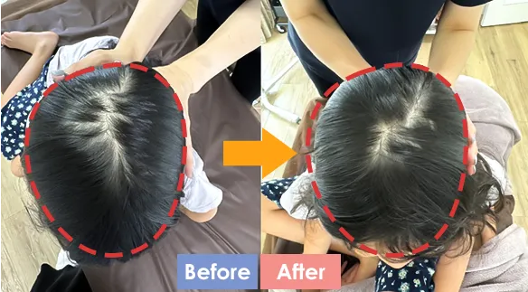 「子供のハチ張り・絶壁を治す」頭蓋骨矯正専門サロン「エクラリー」