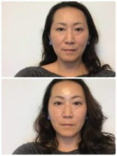 肌再生フェイシャルコース